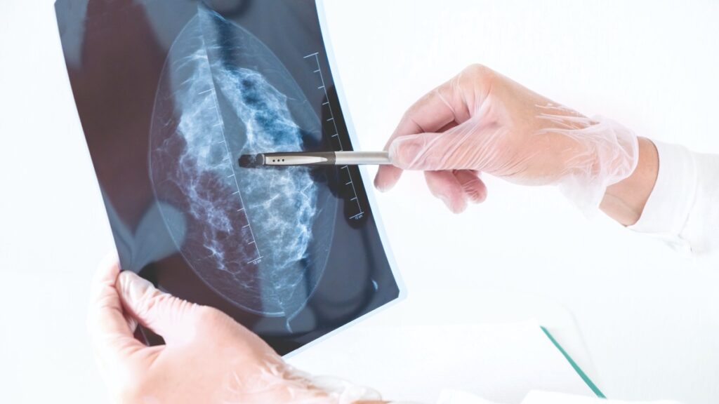 Detección de cáncer de mama