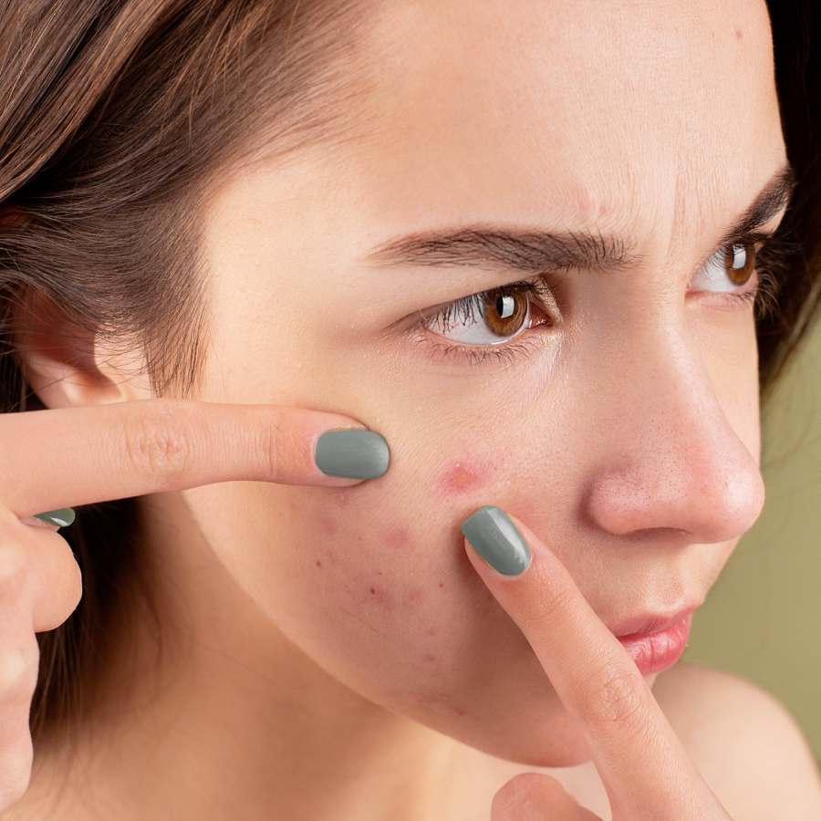 Factores de riesgo para las cicatrices del acné 