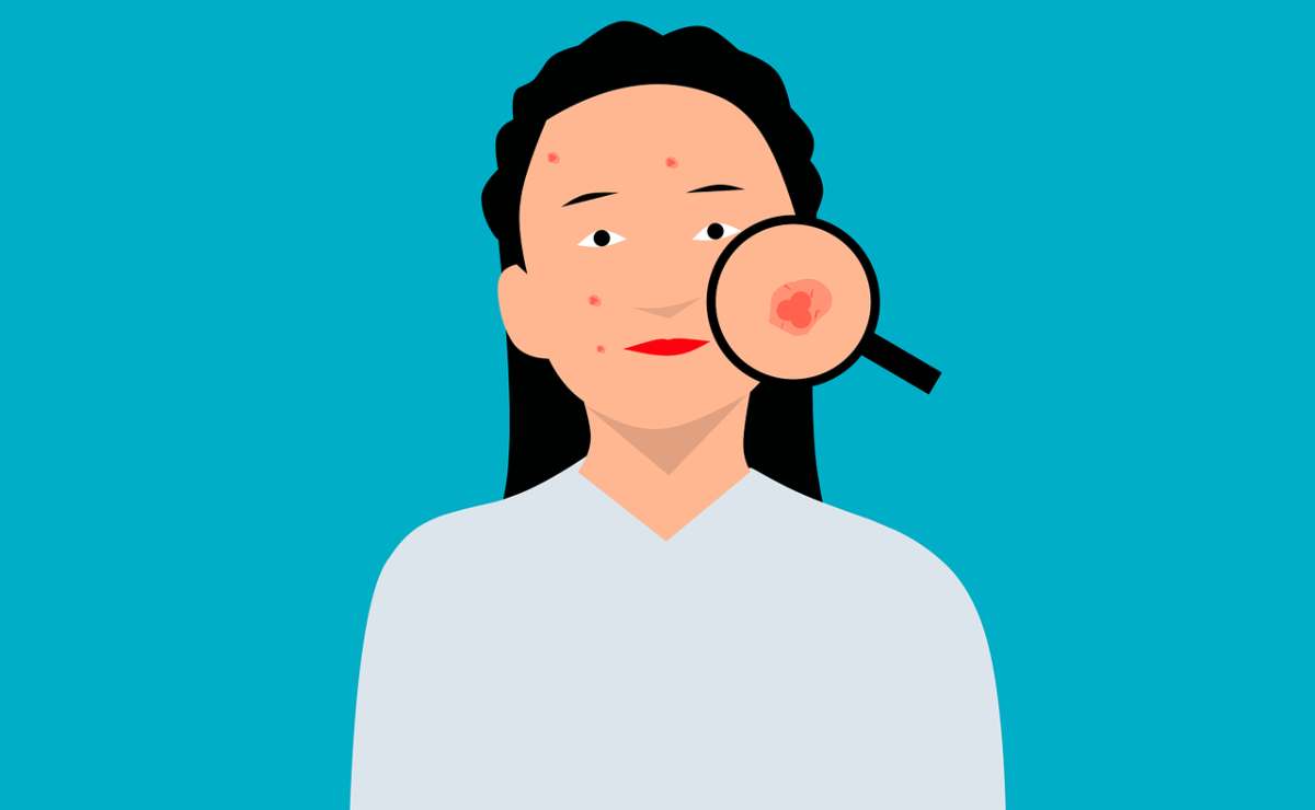 ¿Por qué salen las cicatrices del acné? Los factores de riesgo